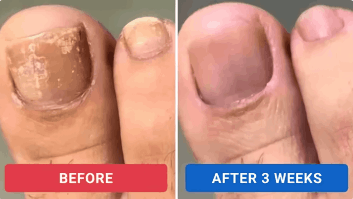 Orivelle Nail Fungus Pen customer review Elena